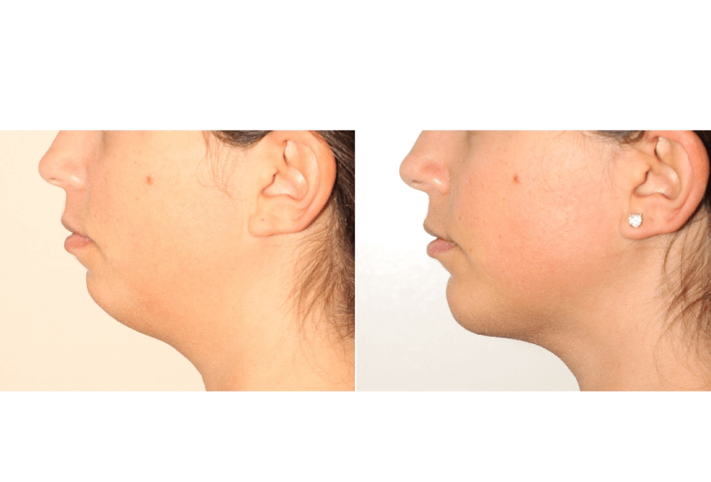 Dr. Denton liposuction and chin implant before and after photo of a female patient