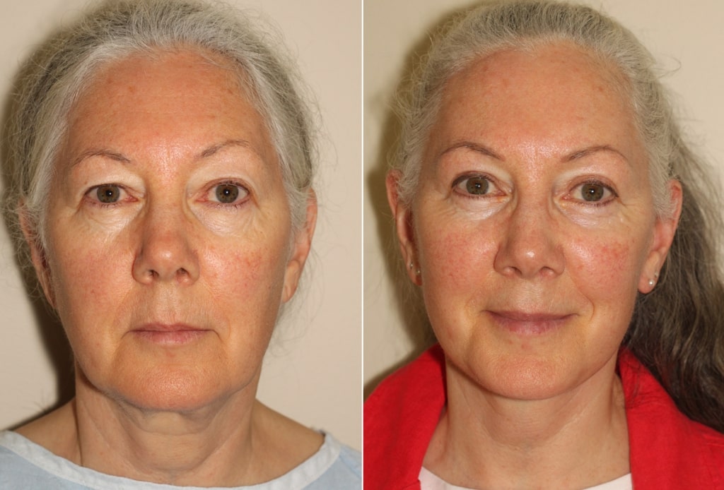 Dr. Denton facelift before and after photo of a female patient