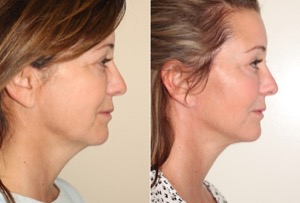 Dr. Denton chin implant before and after photo of a female patient