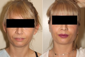 Dr. Denton Otoplasty before and after