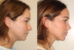 Dr. Denton Rhinoplasty before and after photo of a female patient