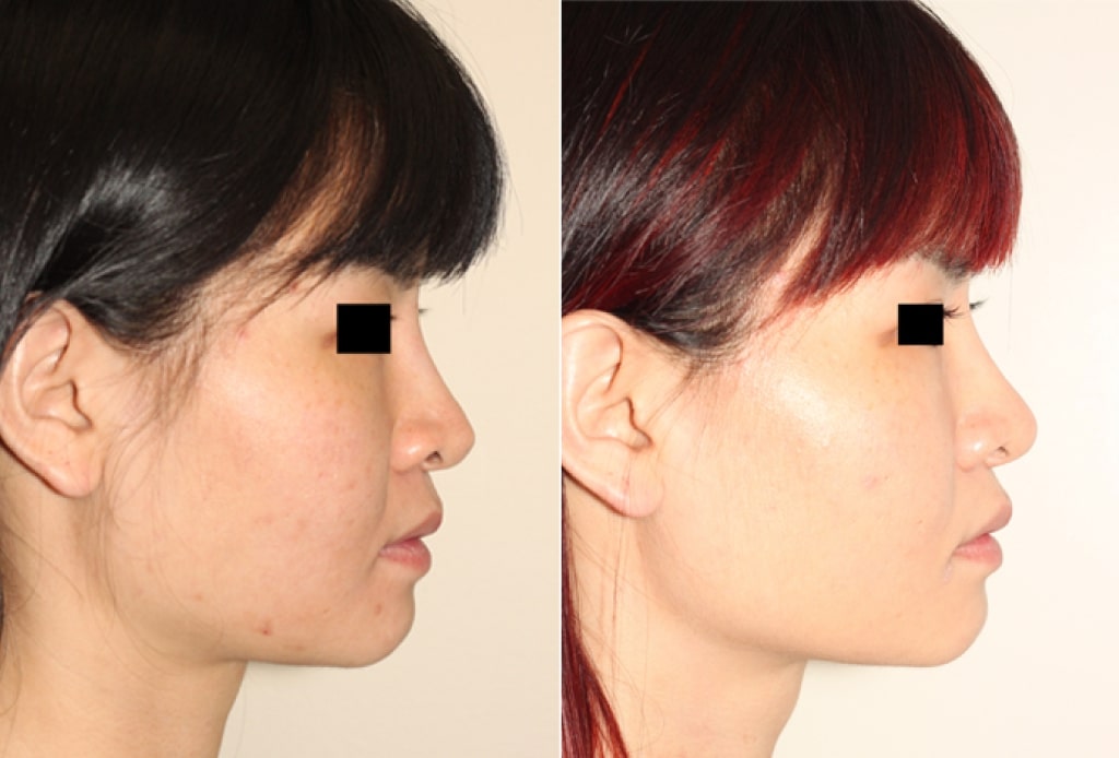 Dr. Denton Asian rhinoplasty before and after photo of a female patient