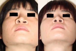 Dr. Denton Asian rhinoplasty before and after photo of a female patient