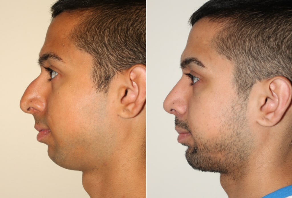 Dr. Denton Rhinoplasty before and after photo of a male patient