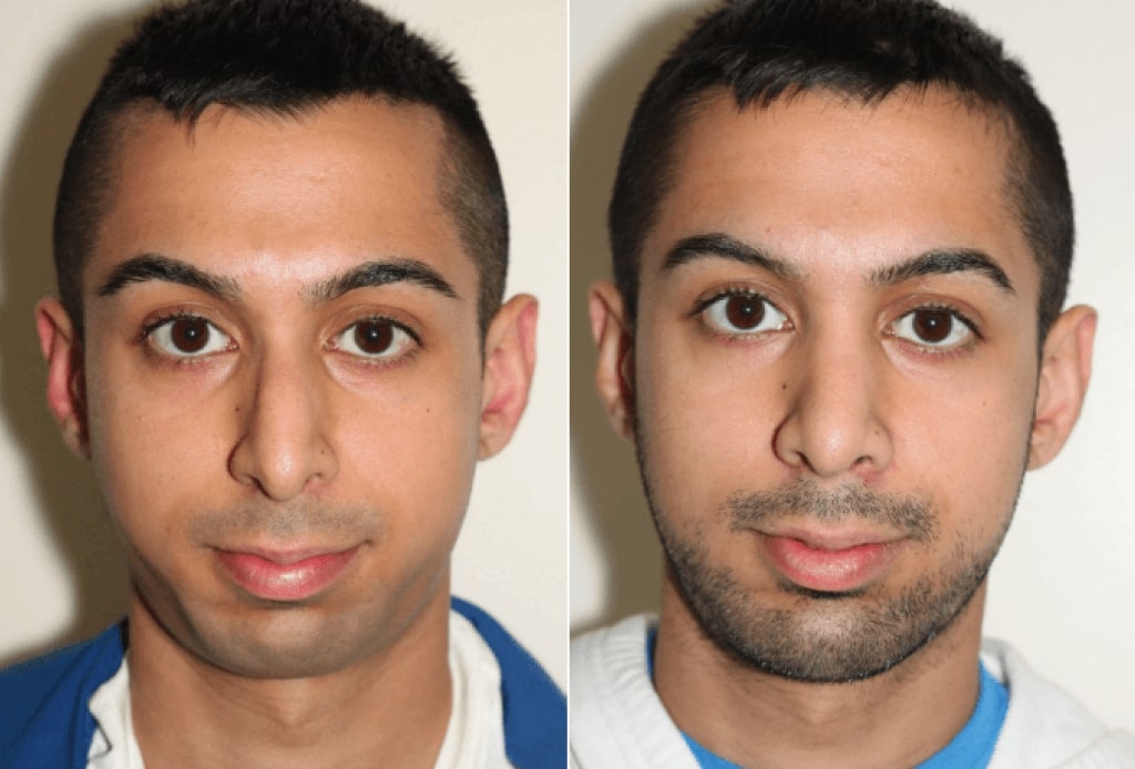 Dr. Denton Rhinoplasty before and after photo of a male patient