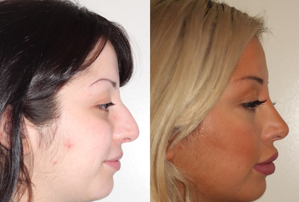 Dr. Denton Rhinoplasty before and after photo of a female patient