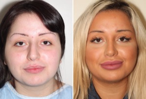 Dr. Denton Rhinoplasty before and after photo of a female patient