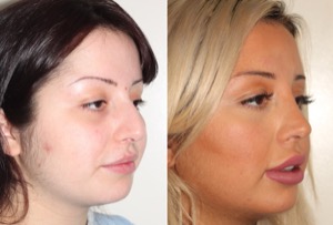 Dr. Denton Rhinoplasty before and after photo of a female patient