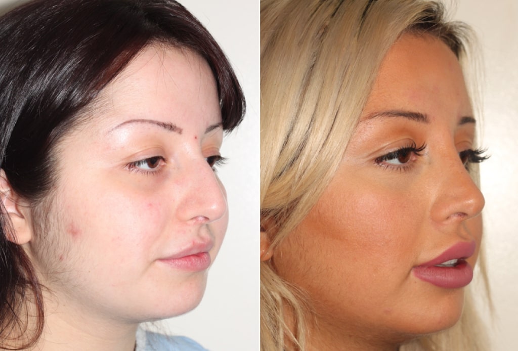 Dr. Denton Rhinoplasty before and after photo of a female patient