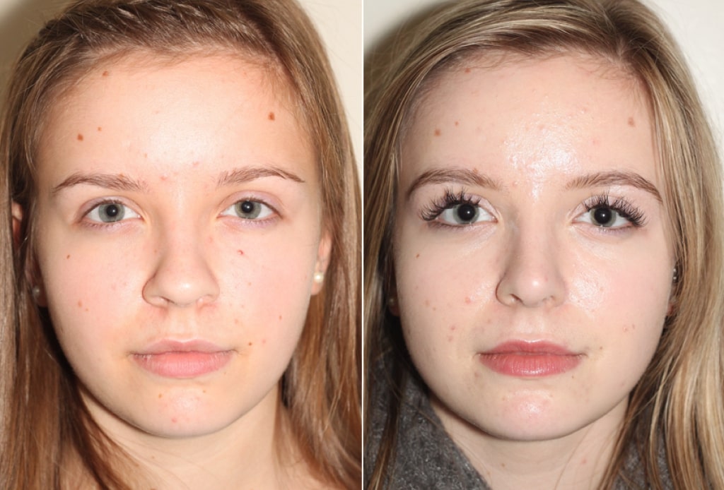 Dr. Denton Rhinoplasty before and after photo of a female patient