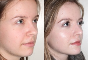 Dr. Denton Rhinoplasty before and after photo of a female patient