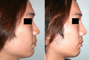 Dr. Denton Asian rhinoplasty before and after photo of a male patient