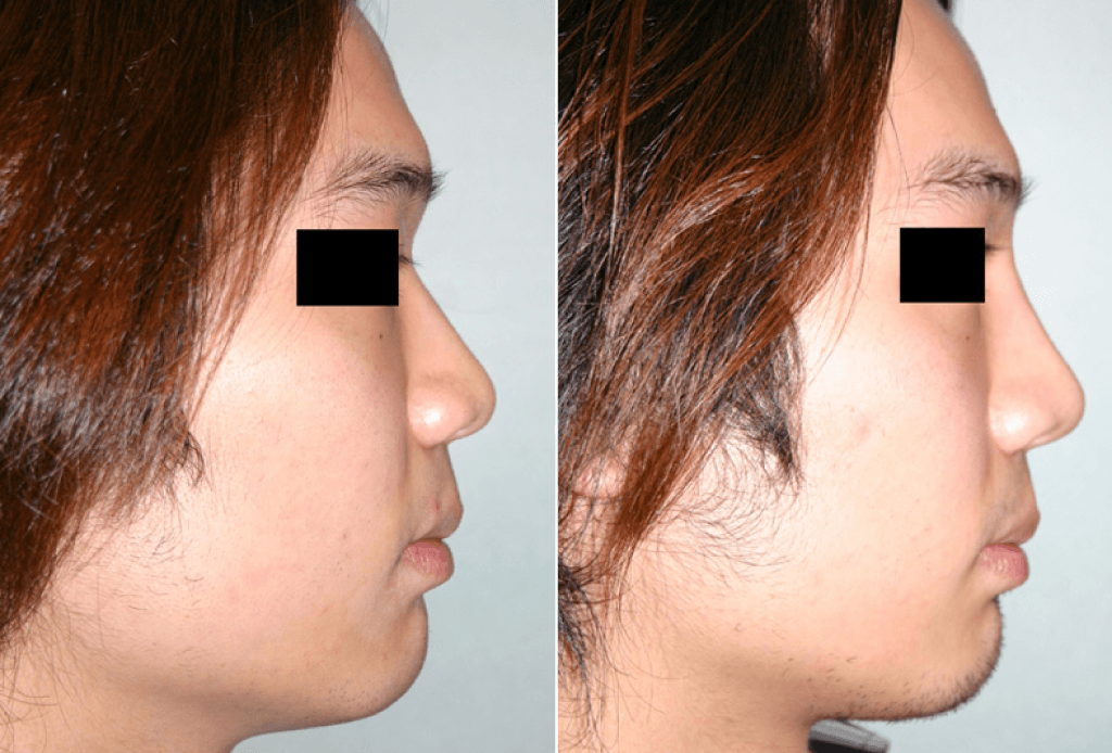 Dr. Denton Asian rhinoplasty before and after photo of a male patient