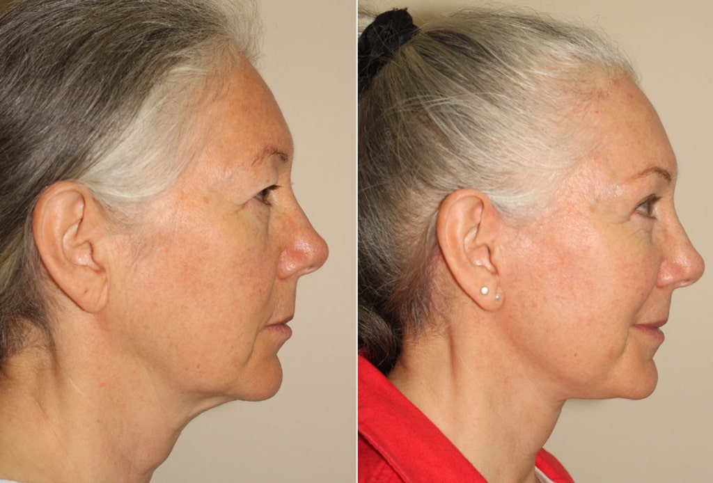 Dr. Denton facelift before and after photo of a female patient