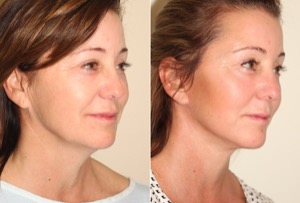 Dr. Denton chin implant before and after photo of a female patient