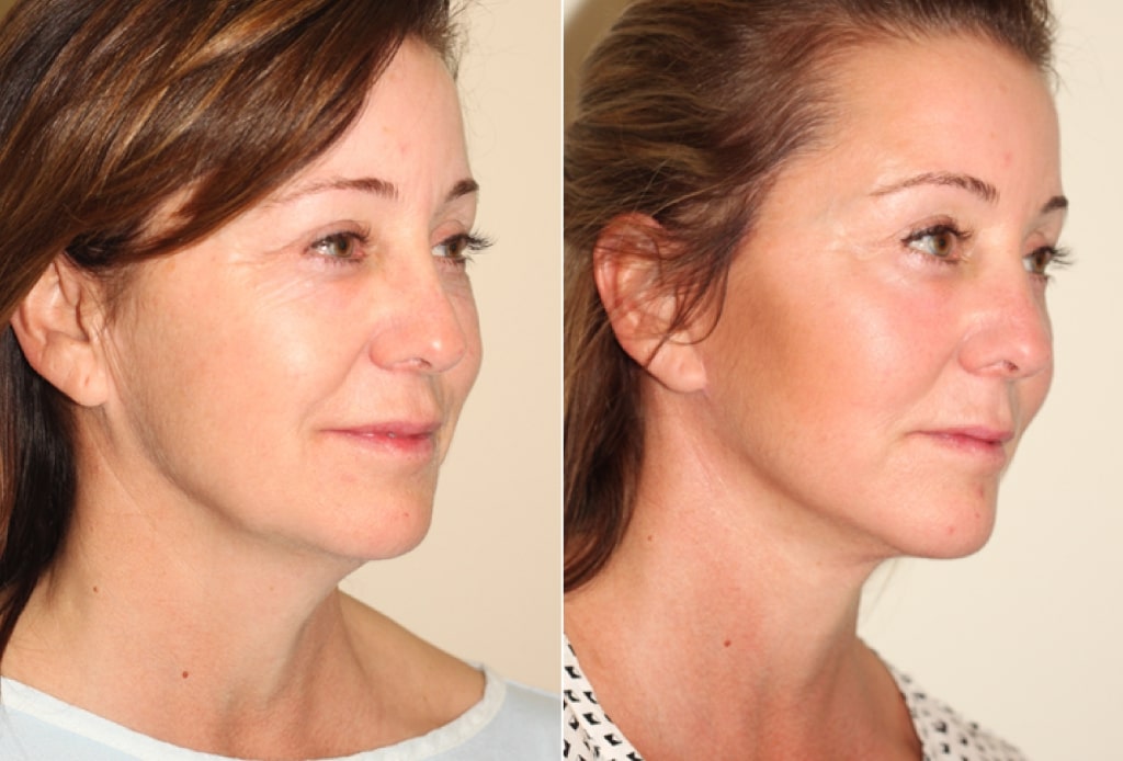 Dr. Denton chin implant before and after photo of a female patient