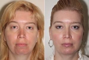 Dr. Denton liposuction before and after photo of a female patient