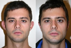 Dr. Denton Otoplasty before and after