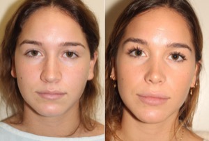 Dr. Denton Rhinoplasty before and after photo of a female patient