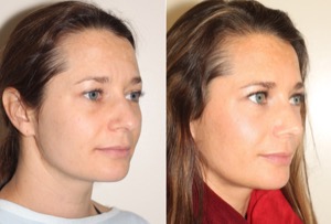 Dr. Denton Rhinoplasty before and after photo of a female patient