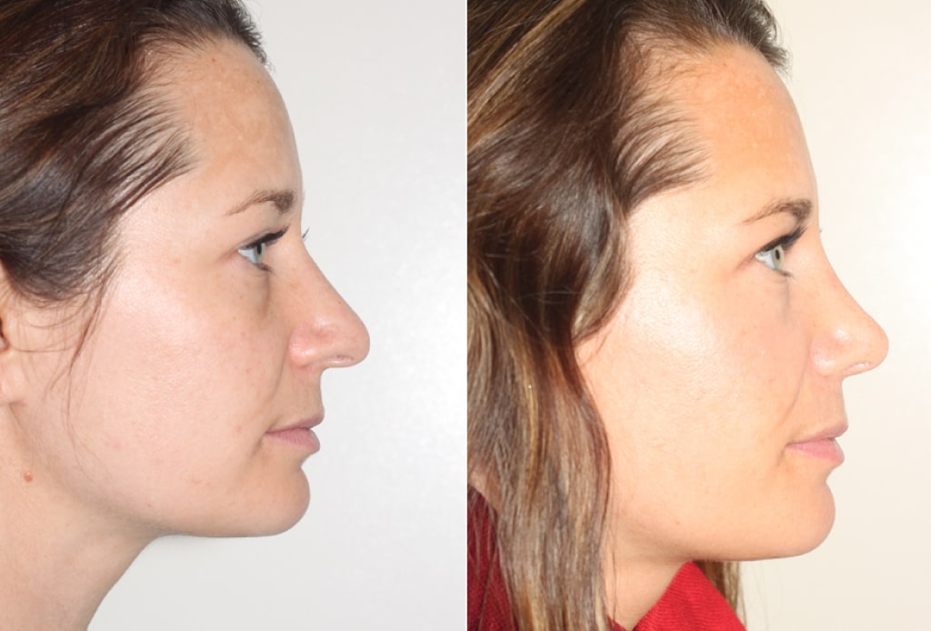 Dr. Denton Rhinoplasty before and after photo of a female patient