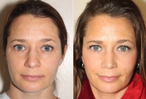 Dr. Denton Rhinoplasty before and after photo of a female patient