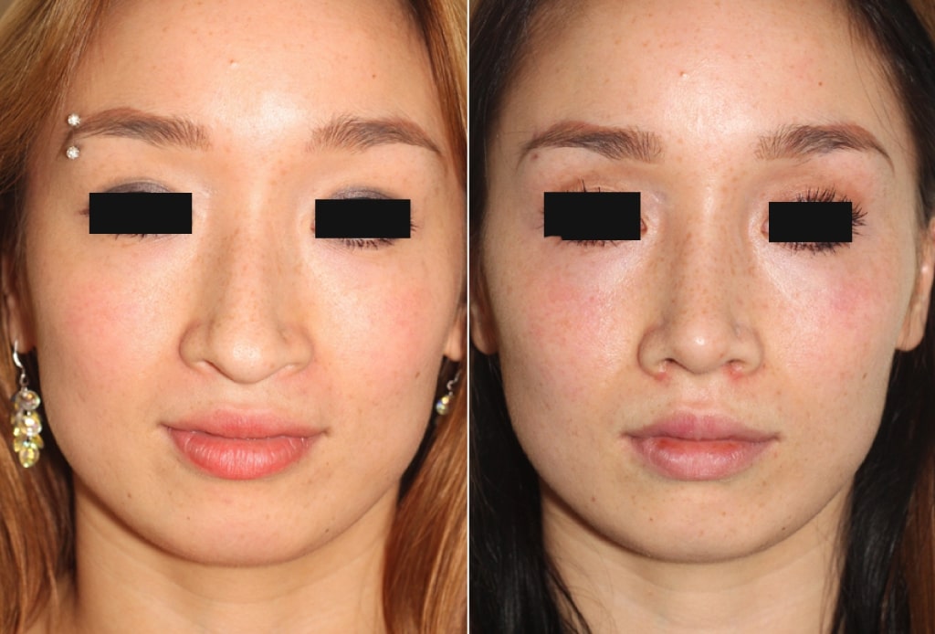 Dr. Denton Rhinoplasty before and after photo of a female patient