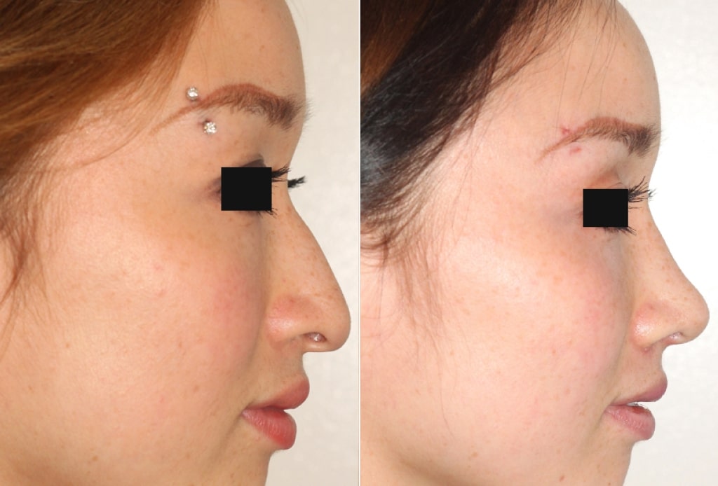 Dr. Denton Rhinoplasty before and after photo of a female patient