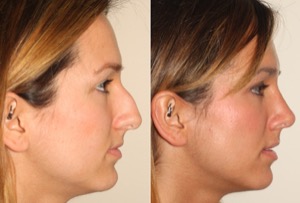 Dr. Denton Rhinoplasty before and after photo of a female patient