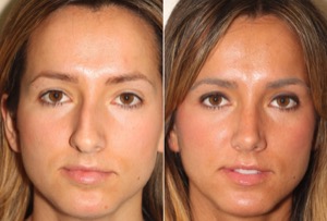 Dr. Denton Rhinoplasty before and after photo of a female patient