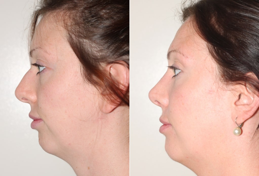 Dr. Denton Rhinoplasty before and after photo of a female patient