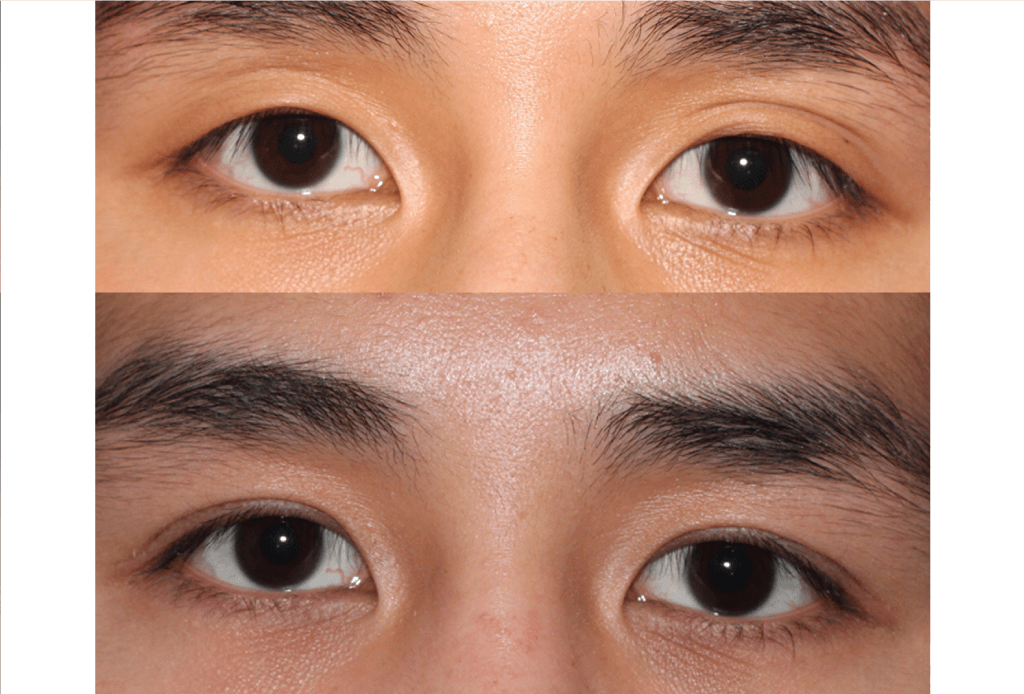 Dr. Denton Asian blepharoplasty before and after photo of a male patient