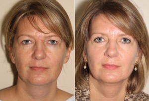 Dr. Denton blepharoplasty before and after photo of a female patient