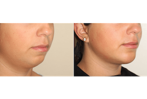 Dr. Denton liposuction and chin implant before and after photo of a female patient