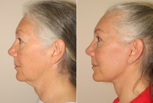 Dr. Denton facelift before and after photo of a female patient