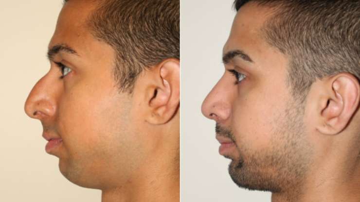 Transform Your Appearance with Profileplasty