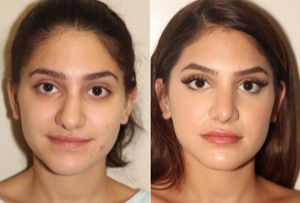 Dr. Denton Rhinoplasty before and after photo of a female patient