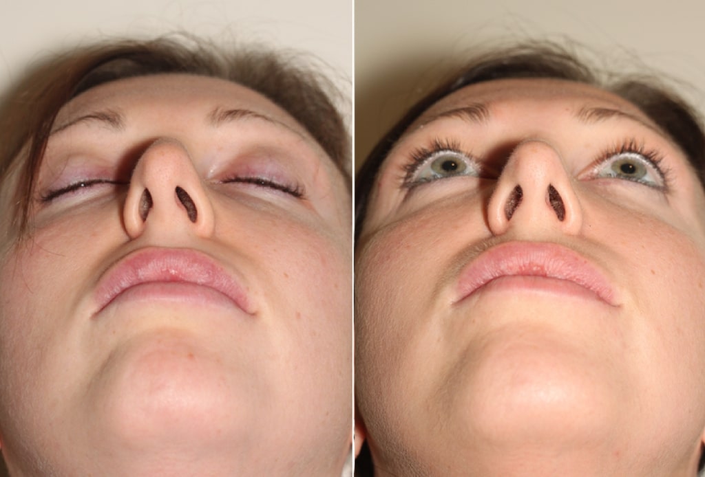 Dr. Denton Rhinoplasty before and after photo of a female patient