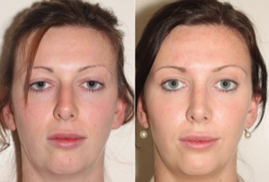 Dr. Denton Rhinoplasty before and after photo of a female patient