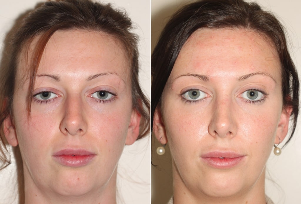 Dr. Denton Rhinoplasty before and after photo of a female patient