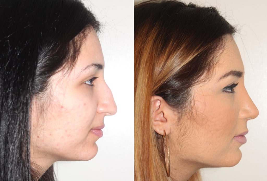 Dr. Denton Rhinoplasty before and after photo of a female patient