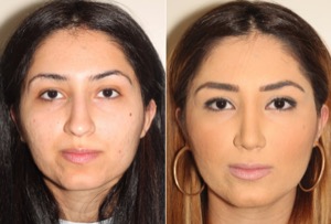 Dr. Denton Rhinoplasty before and after photo of a female patient