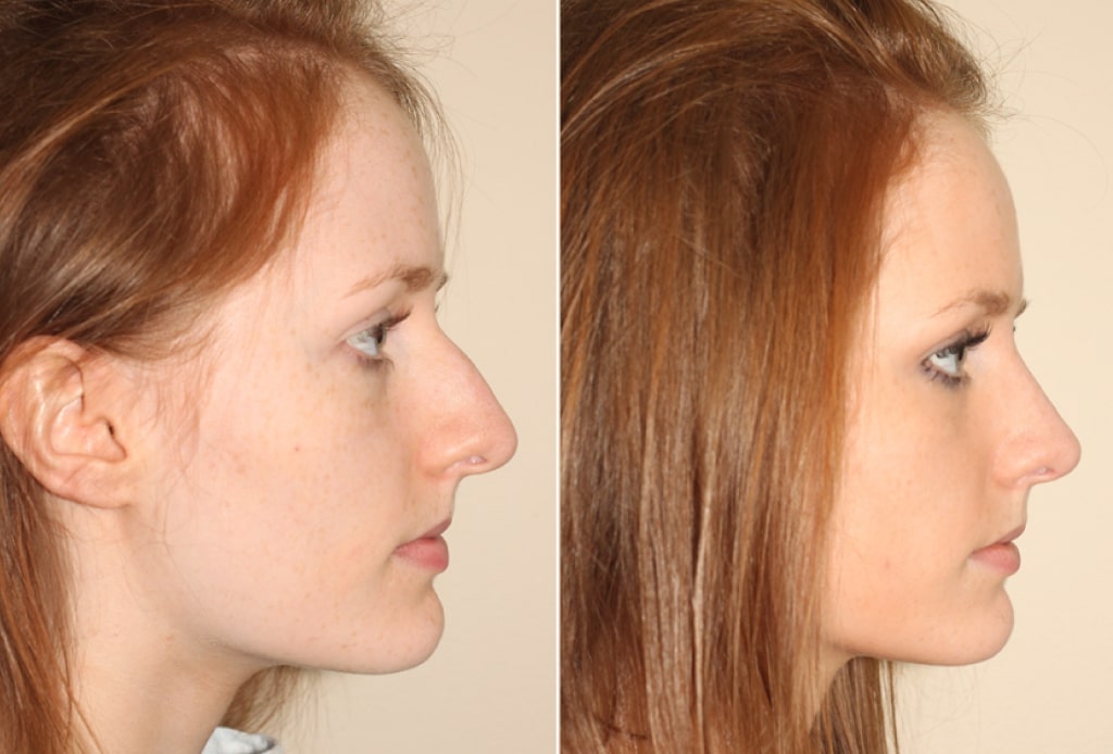 Dr. Denton Rhinoplasty before and after photo of a female patient