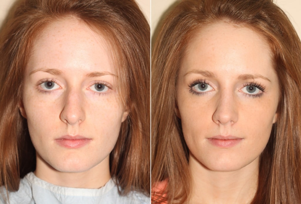 Dr. Denton Rhinoplasty before and after photo of a female patient