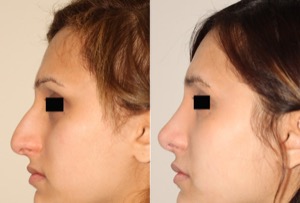 Dr. Denton Rhinoplasty before and after photo of a female patient