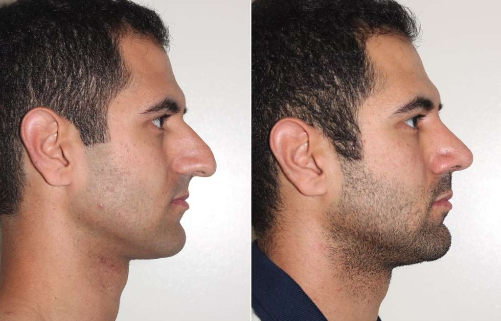 Will My Rhinoplasty Change Over The Years?