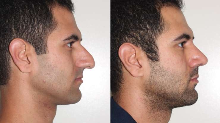 Will My Rhinoplasty Change Over The Years?