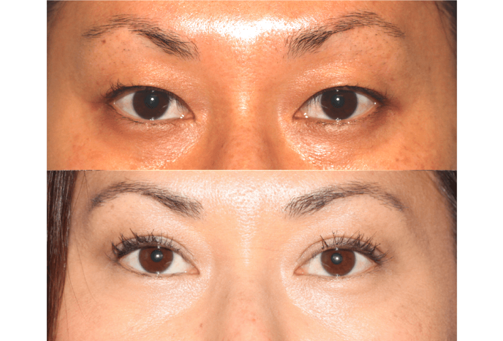 Dr. Denton Asian blepharoplasty before and after photo of a female patient