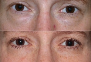 Dr. Denton blepharoplasty before and after photo of a female patient