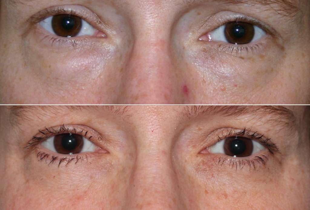 Dr. Denton blepharoplasty before and after photo of a female patient